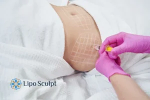 Are The Results From Aqualyx Permanent? 1 Do you want to know how long Aqualyx Merry Hill results last?