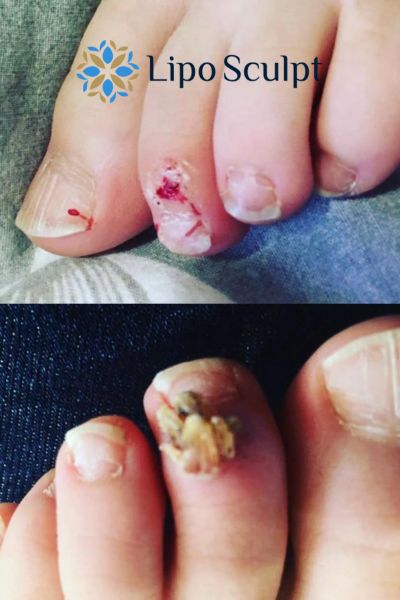 Wart removal customer results from Lipo Sculpt Merry Hill